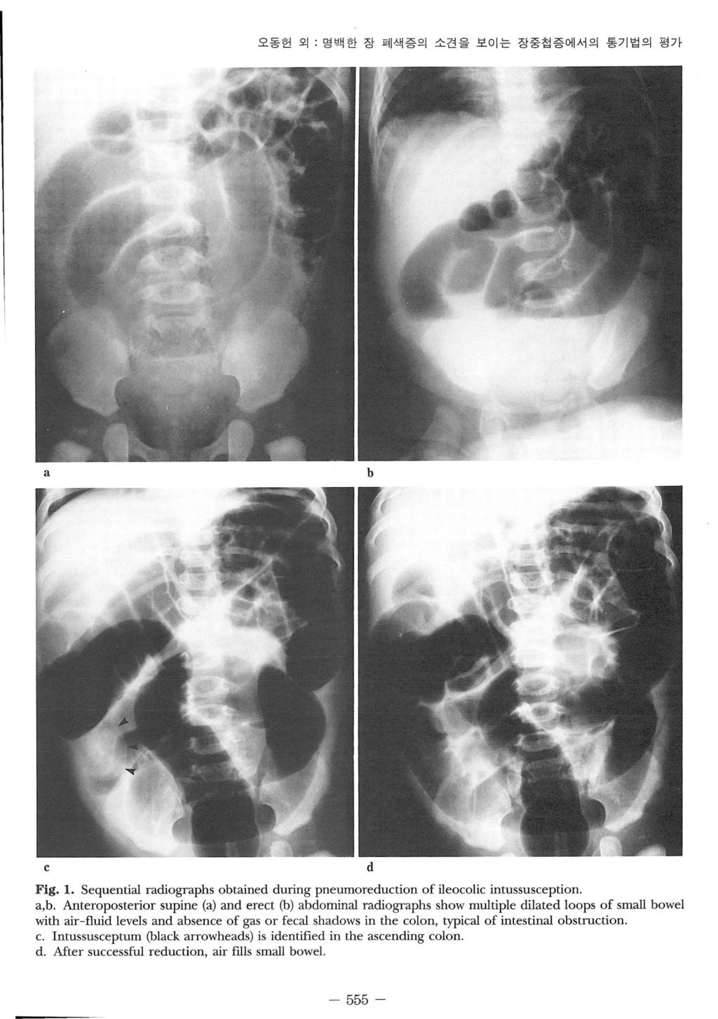 오동헌외 : 명백한장폐색증의소견을보이는장중첩증에서의통기법의평가 a b c Fig. 1. Sequential radiographs obtained during pneumoreduction of ileocolic intussusception. a,b.