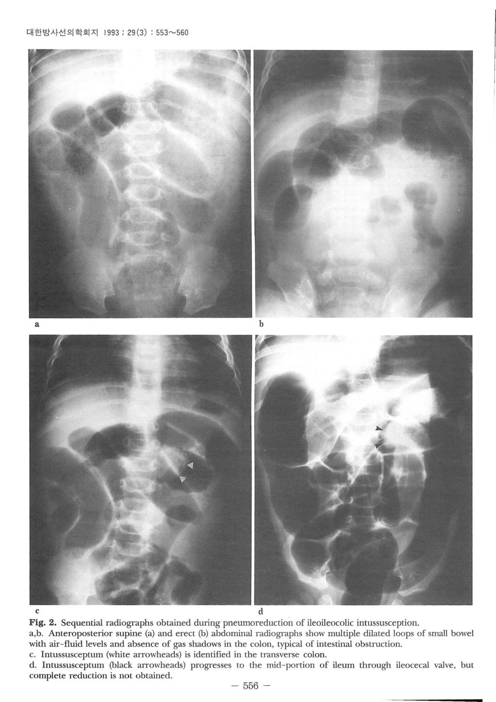 대한방사선의학회지 1993 ; 29 (3) : 553~560 a b c d Fig. 2. Sequential radiographs obtained during pneumoreduction of ileoileocolic intussusception. a,b.