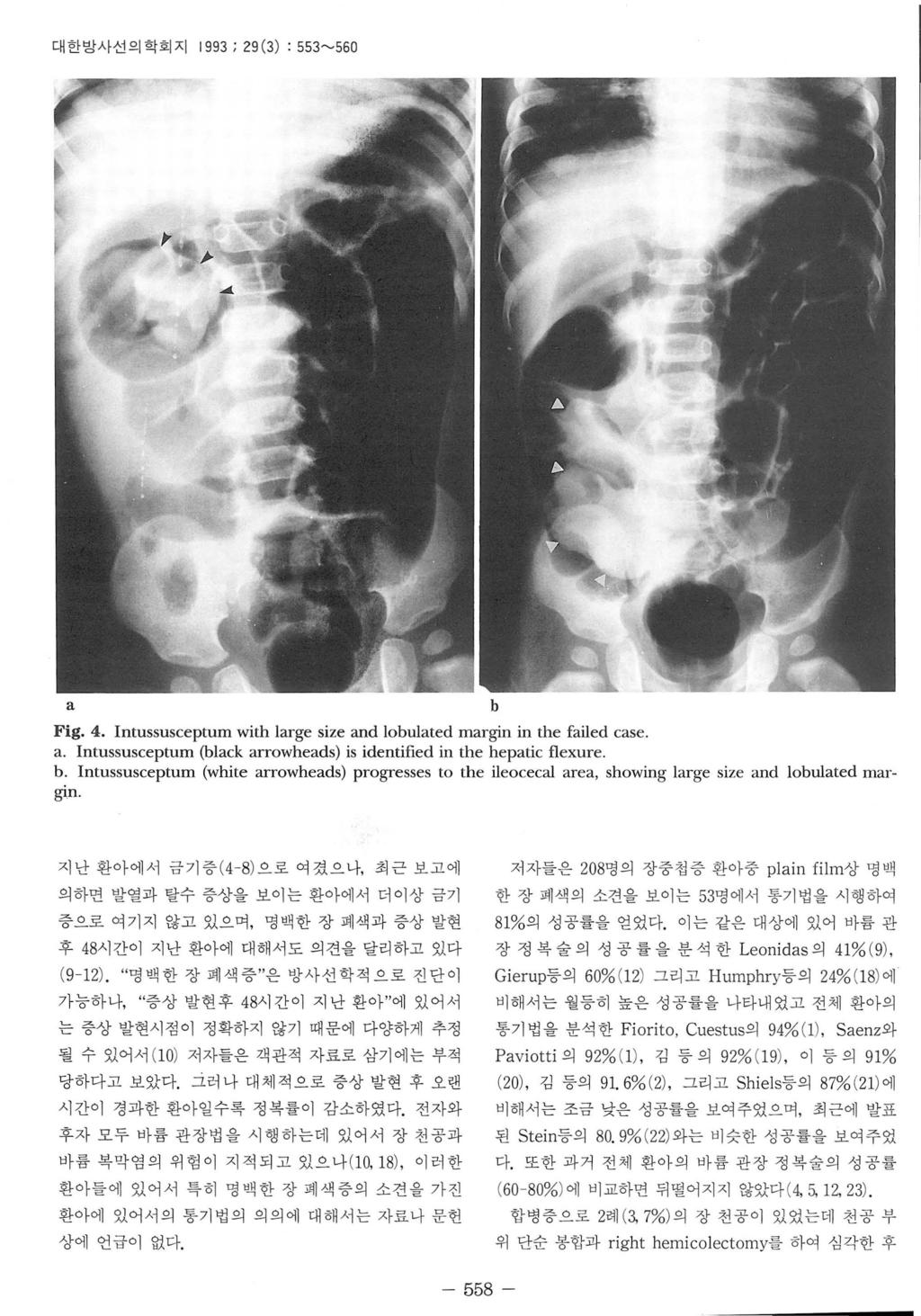 대한방사선의학회지 1993 ; 29 (3) : 553~560 a Fig. 4. Intussusceptum with large size and lobulated margin in the failed case a. Intussusceptum (black arrowheads) is identified in the hepatic f1exure b.