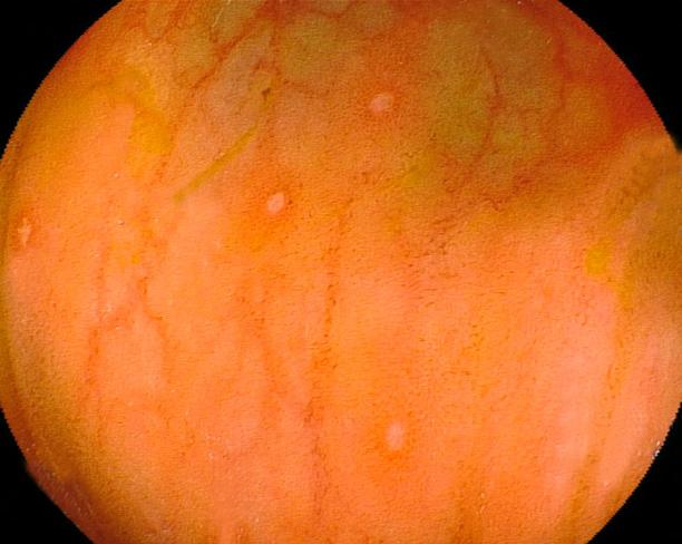 450 대한소화기내시경학회지 2008;37:447-452 Figure 5. Follow-up colonoscopy findings. (A) At anastomosis site, previous superficial ulcers are not noted anymore, however, erythematous mucosal changes are noted.
