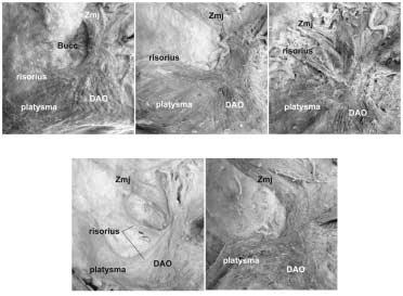 Measurements of the location of the modiolus with the reference to the cheilion (dot: center of the modiolus, unit: mm). Type I Type II Type III Type IV Type V Fig. 5.