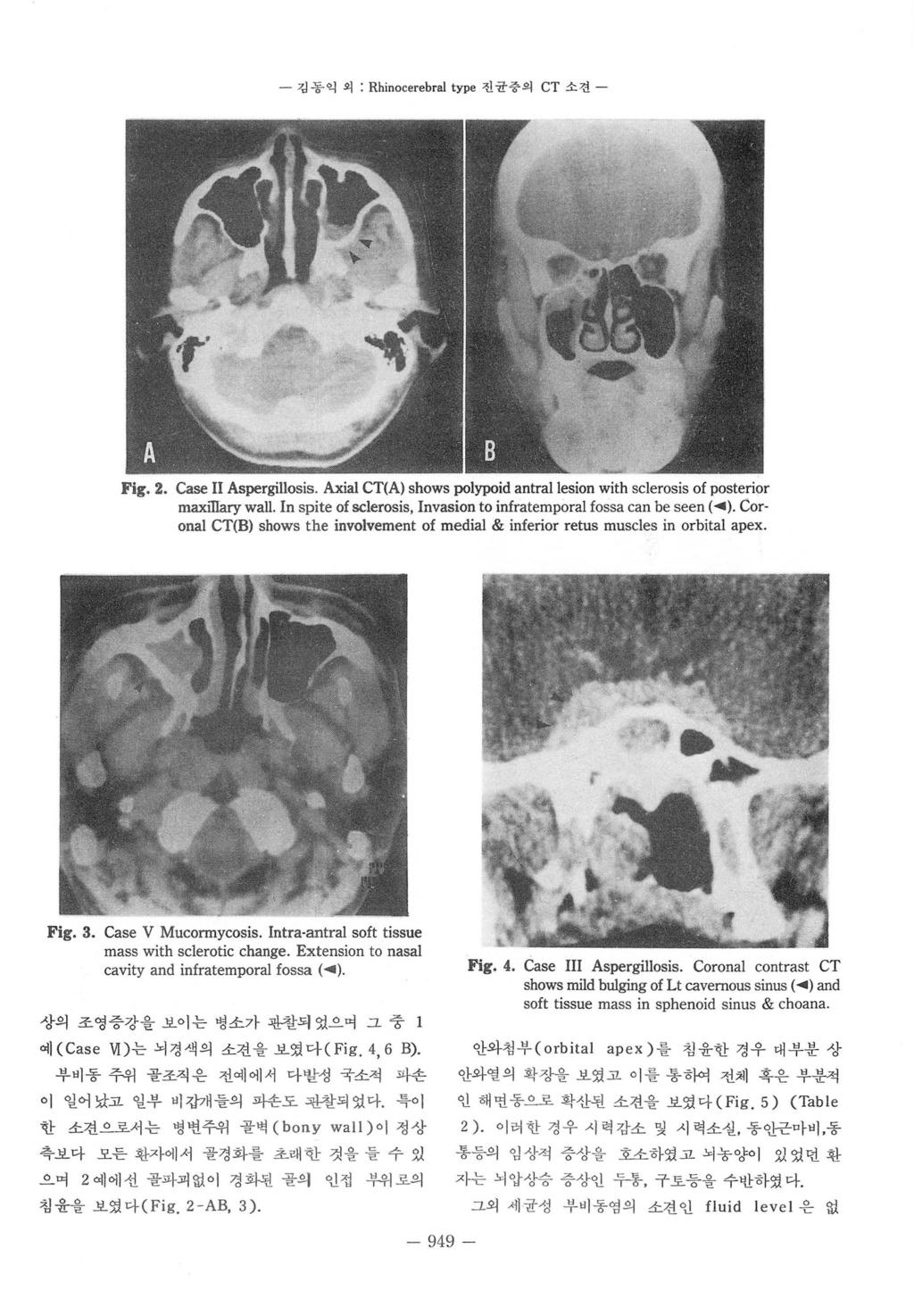 깅동익외 : Rhinocerebral type 진균중의 CT 소견 - Fig.2. Case II Asper밍Ilosis. Axial CT(A) shows polypoid antrallesion with sclerosis of posterior maxiliary wall.