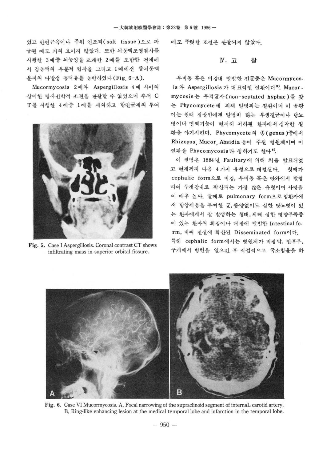 었고안연근육이냐주위연조직 (soft tissue) 으로파에도뚜렷한호선은판창되지않았다. 급된예도거의보이지않았다. 또한뇌동액조영검사를 시행한 3 예중뇌놓양을초래한 2 예를포함한전예에 서경동액의부분적협착올그리고 l 예에선중뇌동액 분지의다발성동액류를통반하였다 (Fig.6-A).