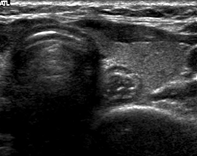 김은경 갑상선 결절의 초음파 85 Fig. 2. Normal esophagus in posterior aspect of left thyroid gland.