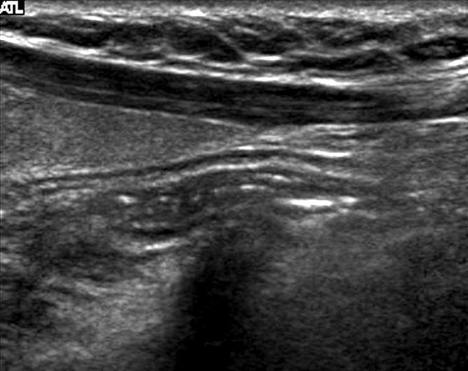 At longitudinal US (B), it changes to be elongated shaped tubular structure (arrows) suggesting normal esophagus. Fig. 3. Normal internal jugular vein.