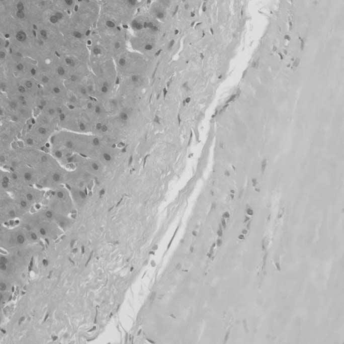 최우선외 a b Fig. 2. Microphotogram of the solitary nectotic nodule of liver. a. High power field microphotogram shows sharp border between normal liver parenchyma and densely hyalinized fibrotic collagenous tissue (Hematoxylin-eosin stain).