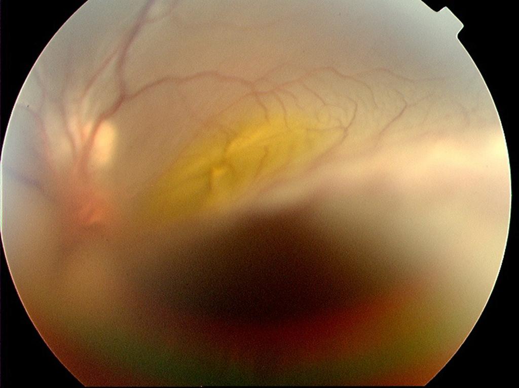 (C) Funduscopic finidng of the intraocular mass.