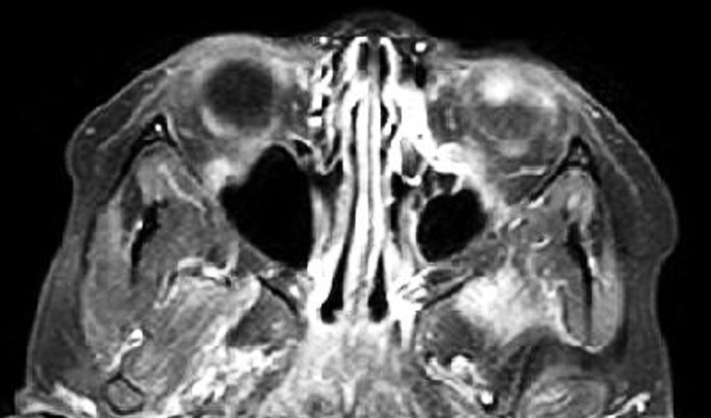 Preoperative CT images; Calcified mass is detected