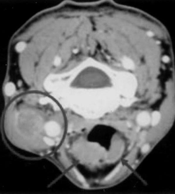 axial,contrast-enhanced CT scan (B) of larynx of Case 2