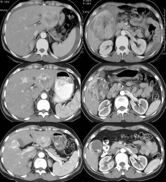 양전호외 6 인 : 간세포암종으로오인된자발성파열을보인간혈관근지방종 1예 A B C Figure 1. Ruptured hepatic angiomyolipoma. (A) Enhanced transverse CT image obtained pre TAE shows a large tumor.