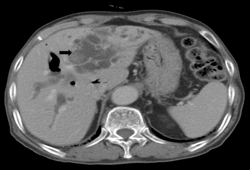 Magnetic resonance cholangiopancreatography shows intraluminal polypoid mass in the gallbladder (arrow) and diffuse dilated biliary system with multifocal intraductal polypoid mass in left side