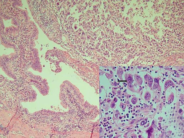 epithelium (H&E stain, 200; inset, H&E stain, 400). Fig. 5. Gross and histolgic findings of gallbladder.