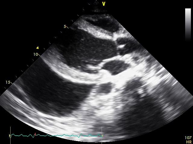 Ho Sup Song, et al. Cardiac tamponade in a patient of lupus nephritis Figure 2.