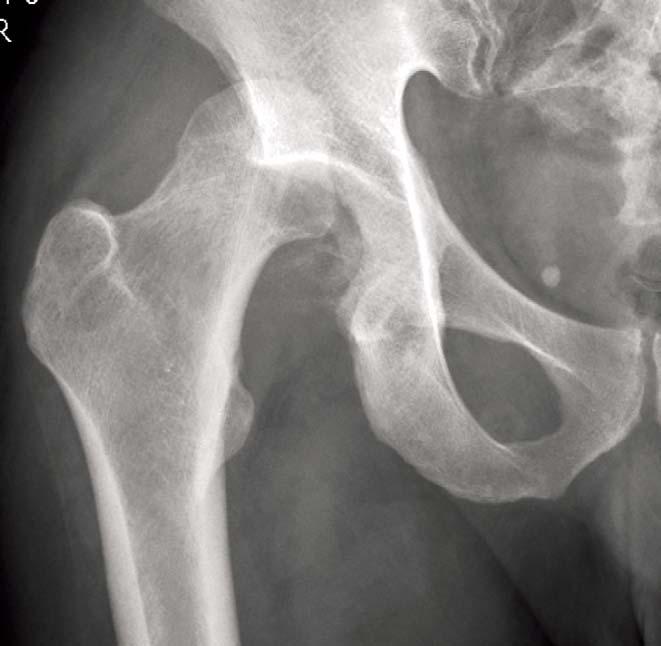 Anteroposterior radiograph of the right hip shows fracture-dislocation and defect of posterior wall of the acetabulum. 비구의후벽이 50% 이상결손되어있었으며, 대퇴골두는전내측이마모되어골결손이있었고골두의골편이관절내에끼어있었다 (Fig. 5).