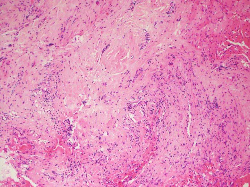 Korean J Otorhinolaryngol-Head Neck Surg 2016;59(4):304-8 A B Fig. 4. Immunohistochemical staining shows diffuse and dense sclerosis (H&E, 100) (A).