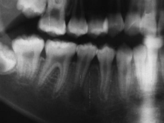 Ⅱ. 본론주로외상이나심한우식으로인하여치수가감염될경우미성숙영구치 (immature permanent teeth) 가생활력을잃을 (non-vital) 수있다.