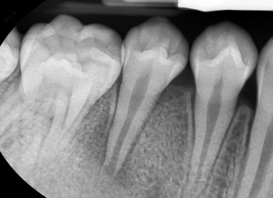 A B Fig 2. (A) Immature root apex with a necrotic infected root canal with apical periodontitis. The canal was irrigated with 1.52% NaOCl and tri-antibiotic paste.