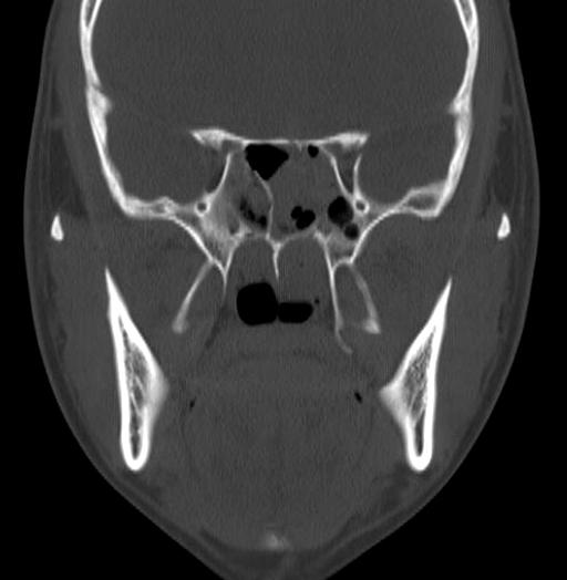 Kyeong Seob Shin, et al. : Post-traumatic S. salivarius Meningitis 93 동정되었으며, 생화학적성상은 Table 1과같았다. 그리고 마크로젠에의뢰한 16S rrna 염기서열분석에서 S. salivarius GenBank AB355616와 99.58% 일치하였다.