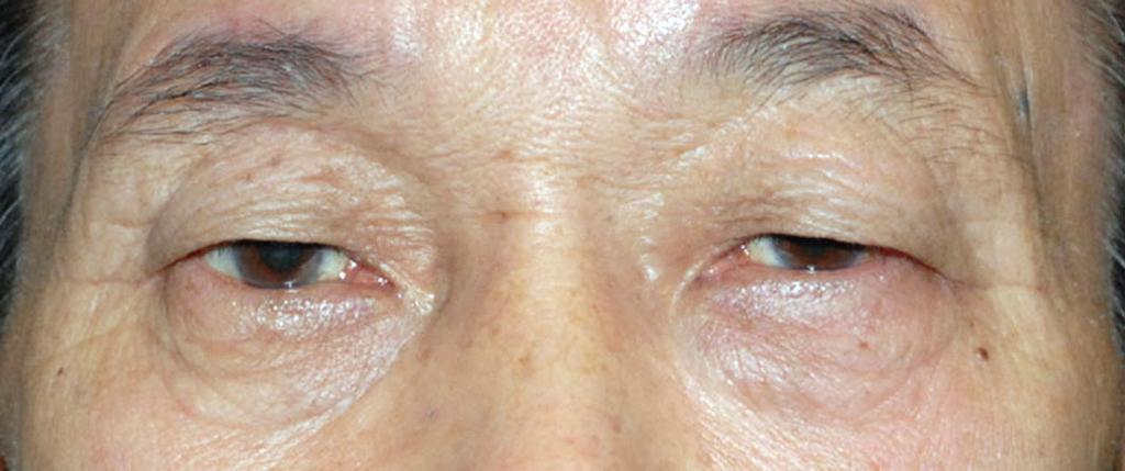 - 대한안과학회지 2013년 제 54 권 제 7 호 - Figure 1. Clinical photograph showing proptosis of the left eye. A B C Figure 2.