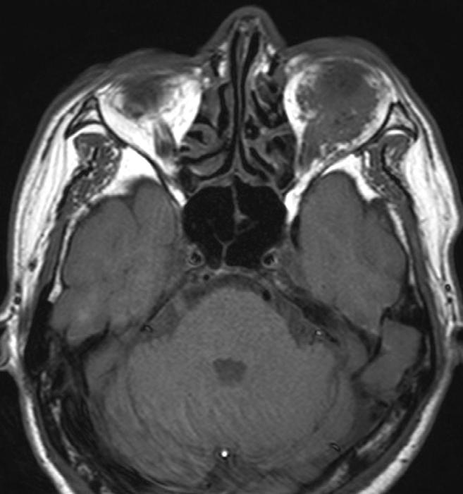 (C) T1-weighted postcontrast image demonstrates a well-enhancing soft tissue mass.