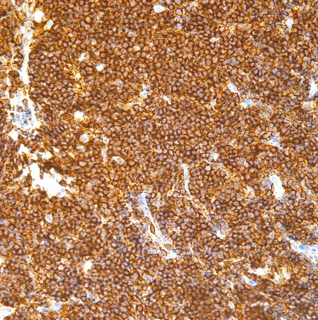 (C) Lymphocytes stain positive for the immunohistochemical stain against the CD20 antigen ( 400).