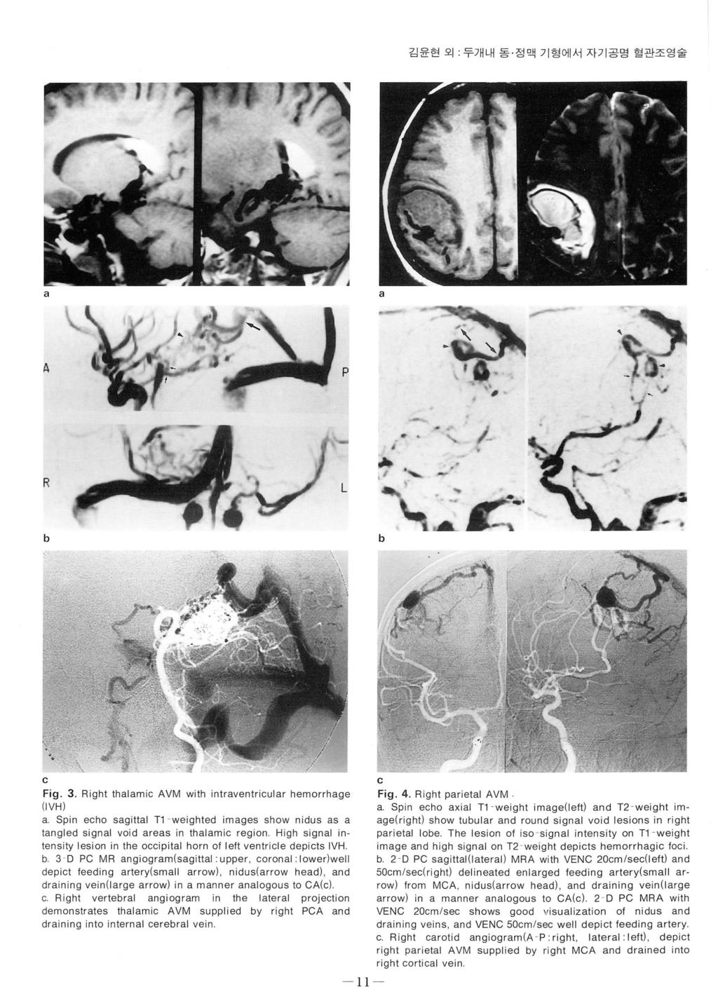 김윤현외 두개내동 정맥기형에서자기공명혈관조영술 P,...,."... it - ".. 륜 - R ig. 3. Right thlmi VM with intrventriulr hemorrhge (IVH). Spin eho sgittl T - weighted imges show nidus s tngled signl void res in thlmi region.