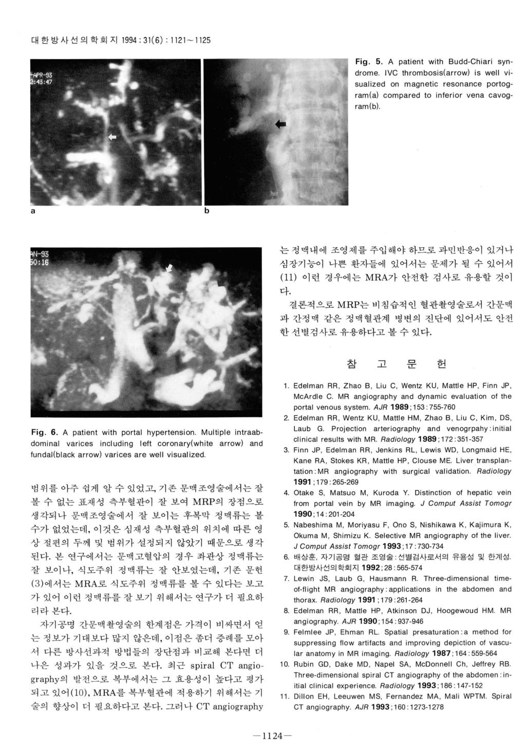 대한방사선의학회지 1994; 31(6) 1121-1125 Fig. 5. A patient with Budd-Chiari syndrome.