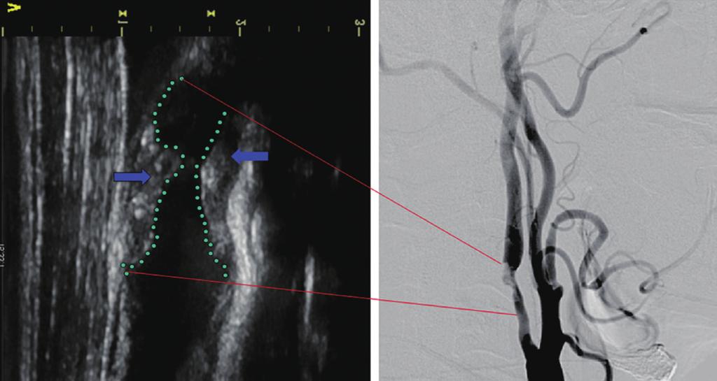 Kim DEJeong SW A B Figure 1. Duplex ultrasonography (A) and angiography (B) imaging to provide structural information about carotid atherosclerosis.