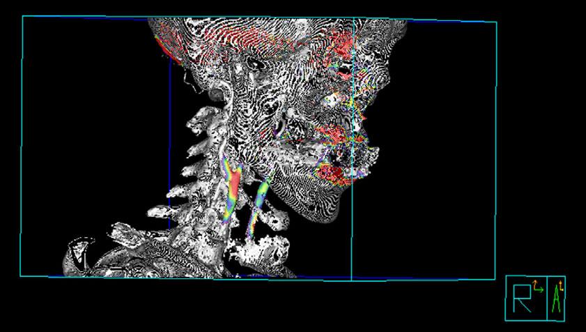 Molecular Imaging of Atherosclerosis Figure 4. Carotid 18 FDG-PET/CT fusion three-dimensional imaging.