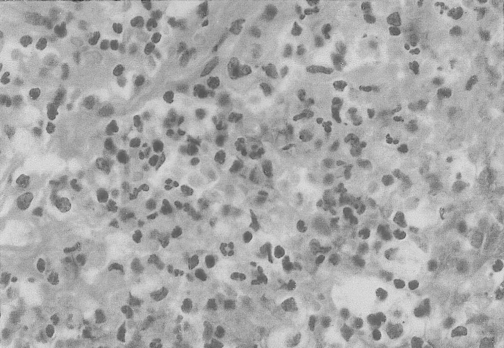 조직학적소견 : 종괴는면역조직화학검사에서 cyto- keratin 양성을보이는섬모성원주세포에둘러싸인낭 종의소견을보였으며 ( 그림 3) 상피세포아래기질에는 림프구와형질세포의심한침윤이관찰되었고 ( 그림 4A, 4B) 종양세포의증거는관찰되지않아라트케열낭종과 동반된림프구성뇌하수체염으로진단되었다.
