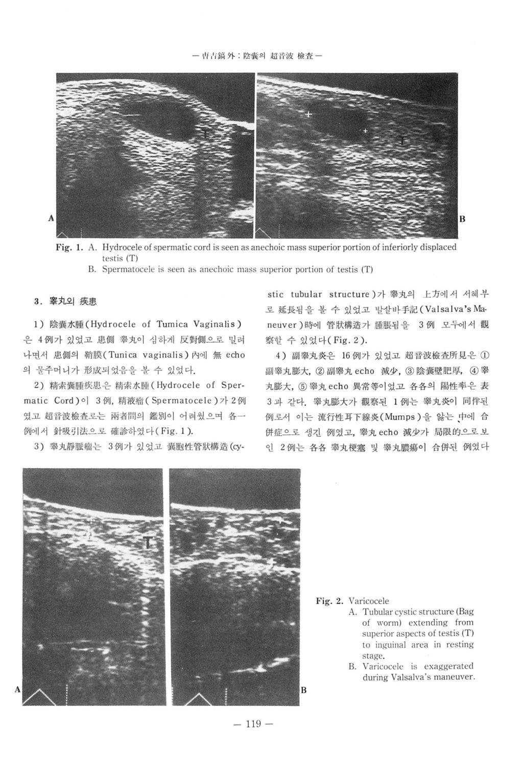 - 씨, l 혜外, 앉싫의,w 히 ilji îft 짚 - A B Fig. 1. A. Hydrocele of spermatic cord is seen as anechoic mass superior portion of inferiorly displaced testis (T) B.