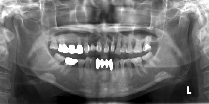() Old prosthesis in right lateral view, () Generalized gingival recession and inappropriate