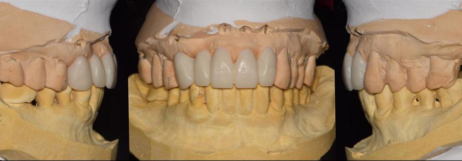 C Fig. 13. Fourth temporary bridge fabrication. () Right lateral view, () Frontal view, (C) Left lateral view. Fig. 15. Final impression taking.