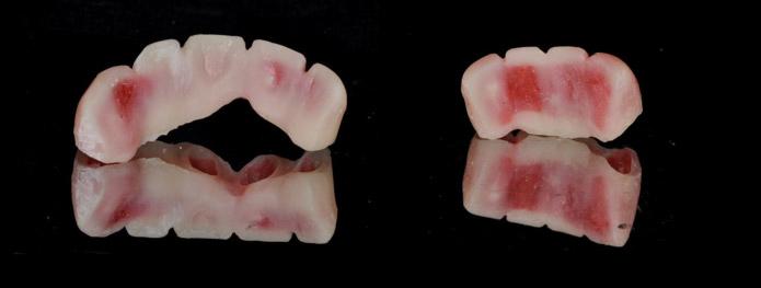 지대치를최종적으로형성하고, 치아색조를선택하였고, 치은부위재현을위해 gingival porcelain 색조도선택하였다. 부가중합실리콘인상재 (Honigum, DMG, Hamburg, Germany) 를이용하여최종인상을채득하였다 (Fig. 15).