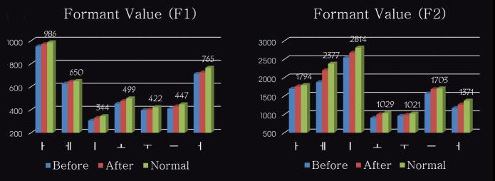 Increased formant value in phonetic analysis by Praat software after treatment. Fig. 22.