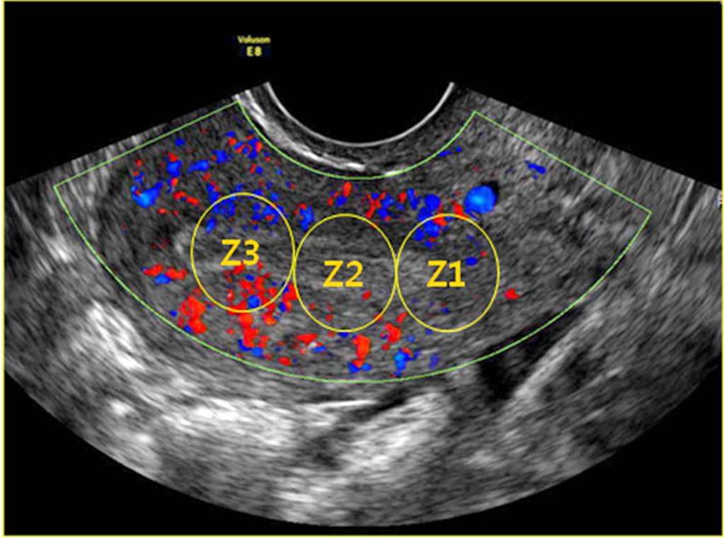 KJOG Vol. 55, No. 7, 2012 Fig. 3. Measurement of uterine blood flow by Doppler ultrasonogram.