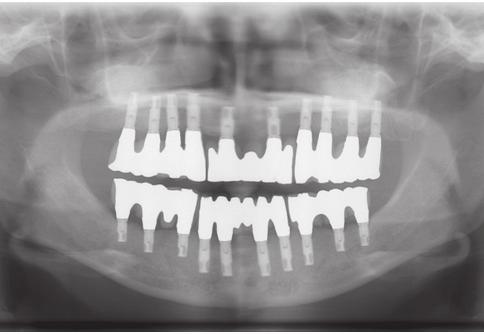 성공적인임플란트의조건과임플란트의합병증 그림 3) 성공적인임플란트는구강내의모든치아를임플란트로수복할수도있고 ( 좌측 ), 치아하나를 수복할수도있다 ( 우측,
