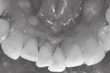 치아면에붙어서제거되지않고오래남아있게되면점차나쁜독소를만들어염증을일으키고치조골을파괴하게되어치주질환을일으키게된다.
