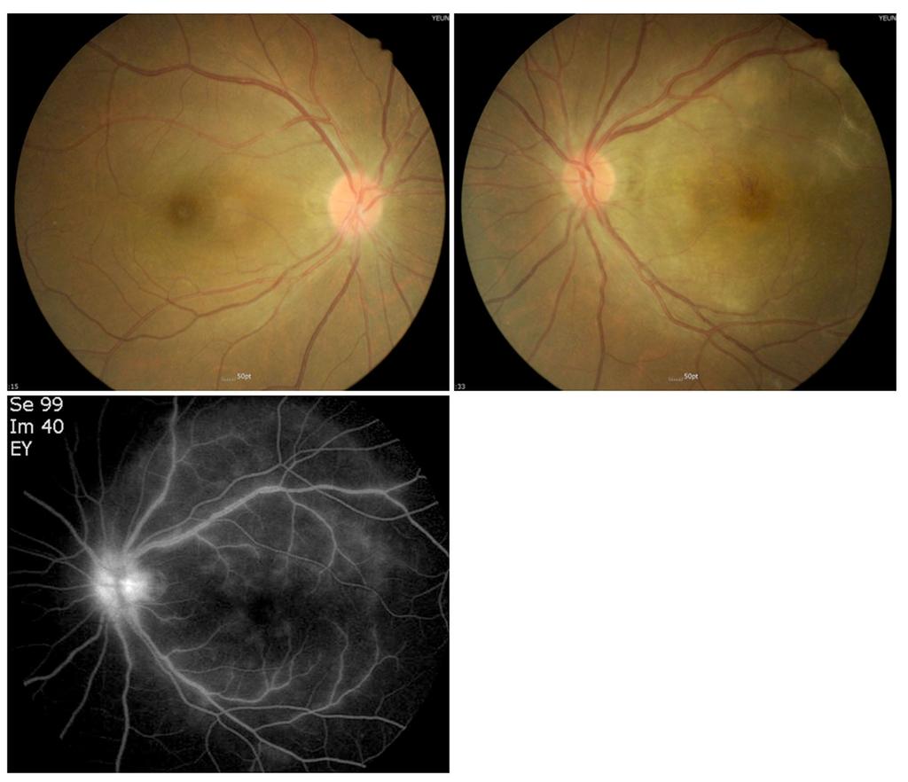 (, ) The fundus photography of the left eye shows chorioretinitis with vasculitis. (C) The fluorescein angiography shows leakage from lesions and retinal vessels. 문학과미술작품에서도그존재를확인할수있다.