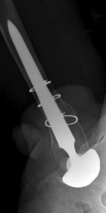 2 (74 100) Complication related to opeartion Intraopeative calca crack or fracture of proximal femur Early dislocation (<3 mo) 1 Periprosthetic infection (<1 mo) 0 Thigh pain (>6 mo) 4