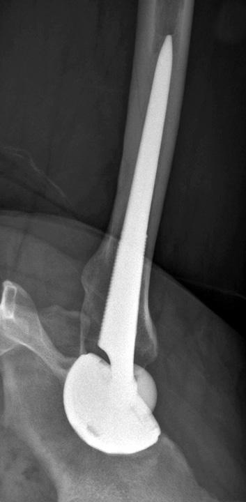 (A) Simple anteroposterior and lateral radiographs of the hip joint taken immediately