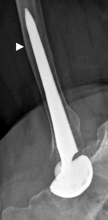 (B) Anteroposterior and lateral radiographs of the hip joint taken 9 years after the