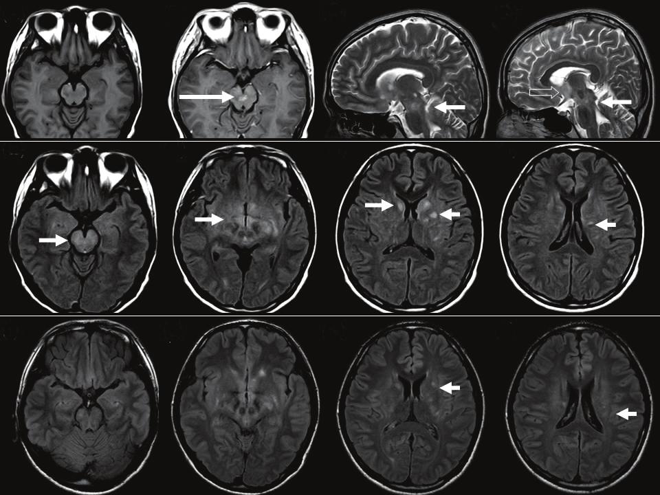Figure 2. rain MRI of the patient.