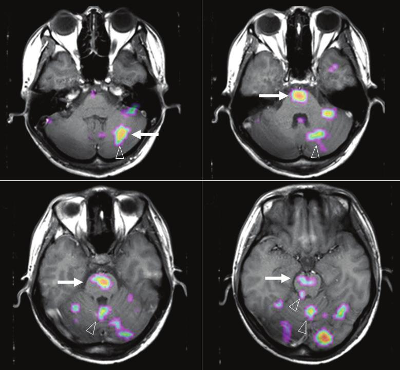 D Figure 3. Subtraction ictal single-photon emission computed tomography (SPET) coregistered to MRI (SISOM) images.
