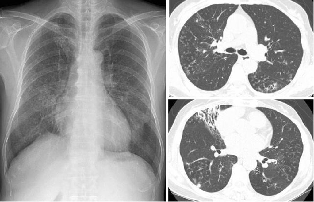 M. abscessus pulmonary disease in a 60 year old woman. Chest radiograph shows multifocal patchy areas of small nodular clusters in both lungs. Transaxial lung window CT images (2.