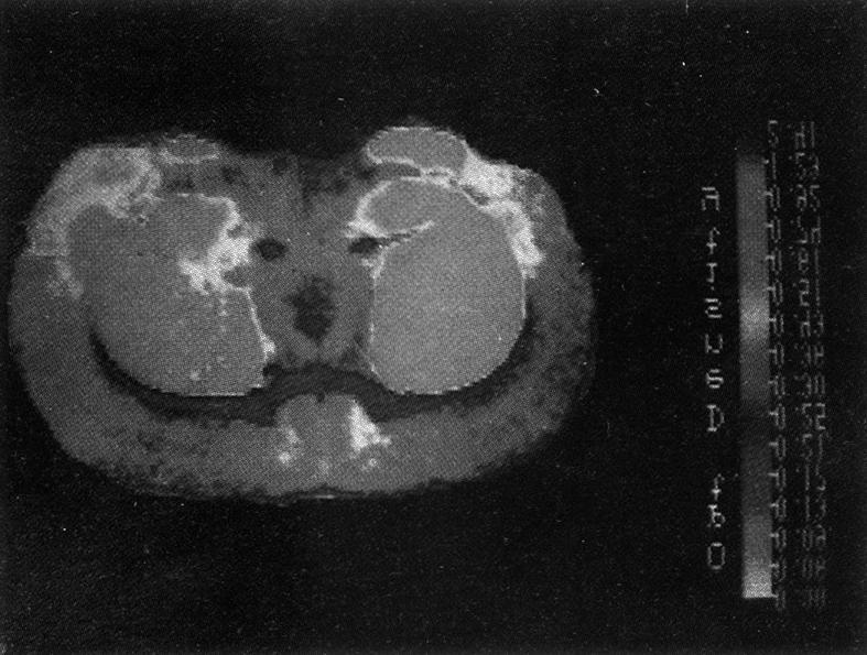 Fig. 6. Autoradiographic distribution of [ 3 H]SCH 23390 binding in caudate-putamen and nucleus accumbens.