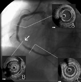- 손원외 6 인 : 전신홍반루푸스에서발생한조기관상동맥질환 3 예 - Figure 5. A coronary angiogram (CAG) from case 3.
