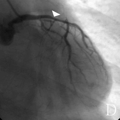 circumflex coronary artery (D).