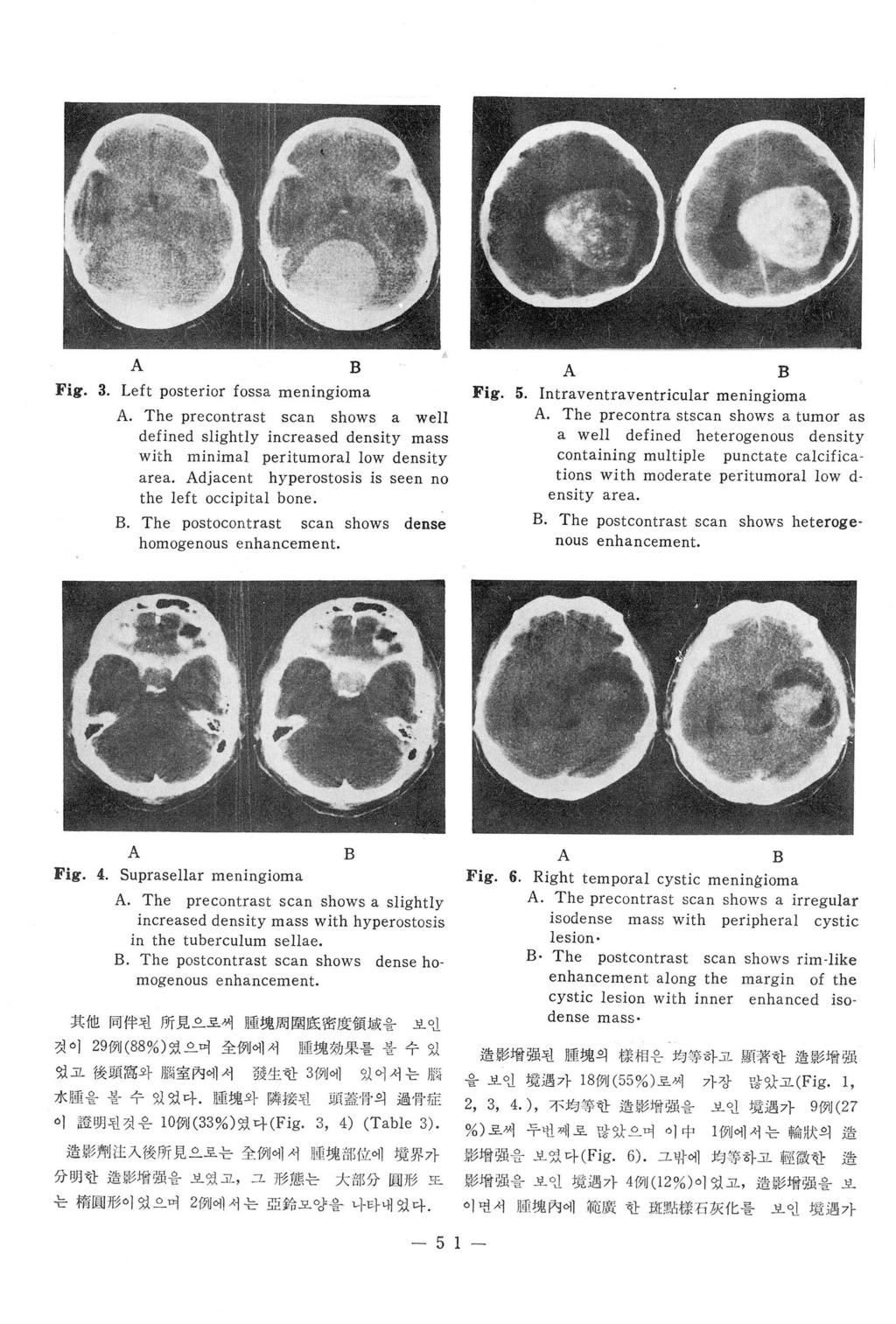 Fig. 3. Left posterior fossa meningioma. The precontrast scan shows a well defined slightly increased density mass with minimal peritumoral low density area.