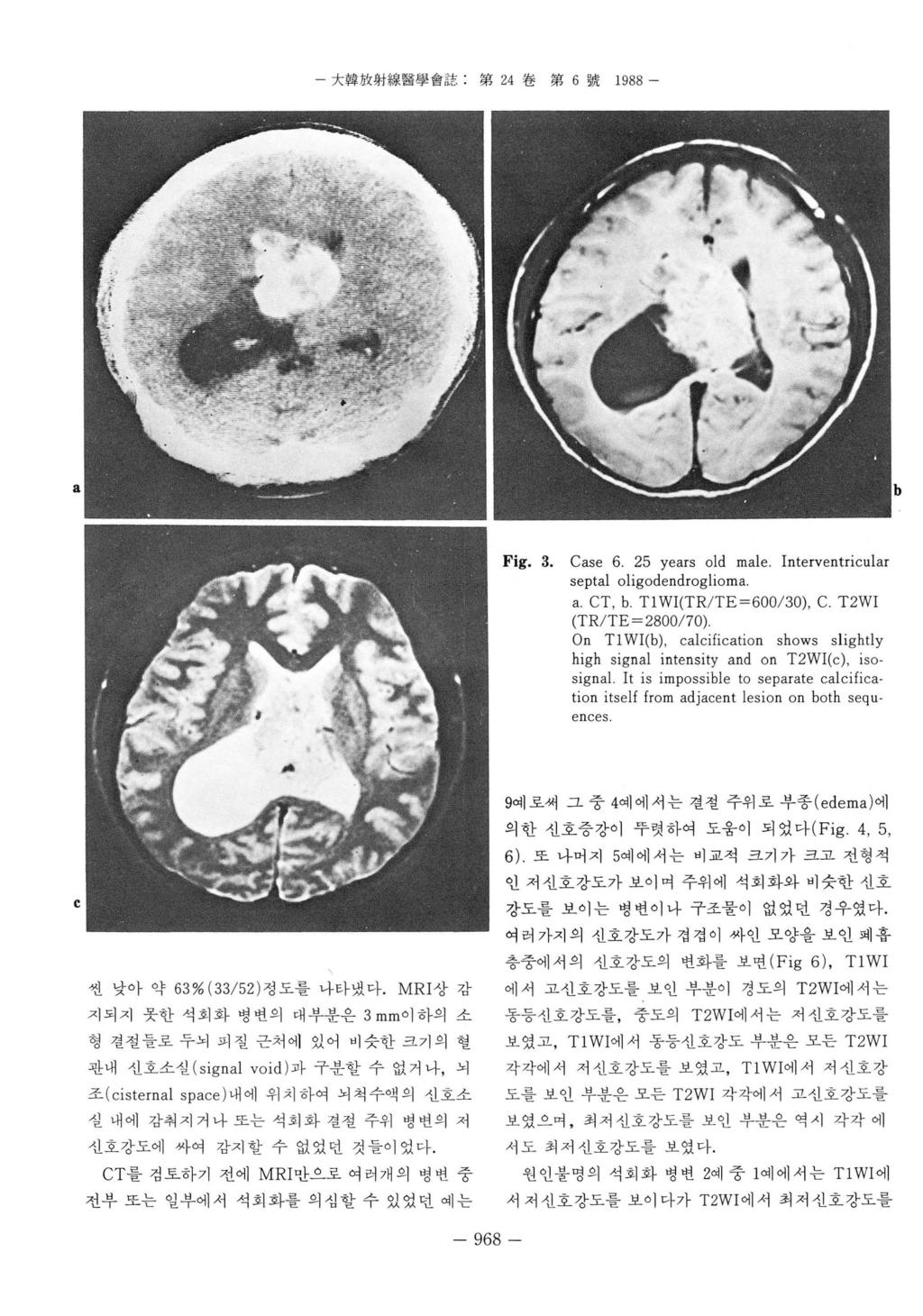 - 大韓放射線훌훌學會註 : 第 24 卷第 6 號 1988 - a Case 6. 25 years old male. Interventricular septal oligodendroglioma a. CT, b. Tl WI(TR/TE=600/30), C.